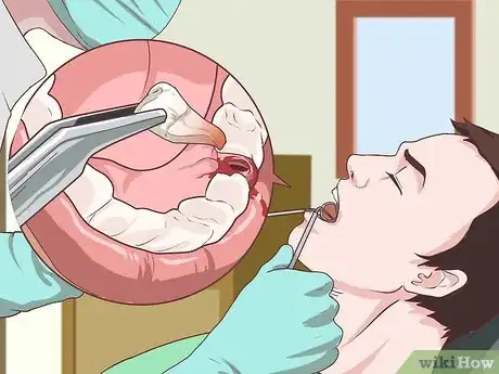 Image titled Prepare for Tooth Extraction Step 10