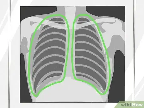 Image titled Know if a Chest X Ray Film Is Rotated Step 7