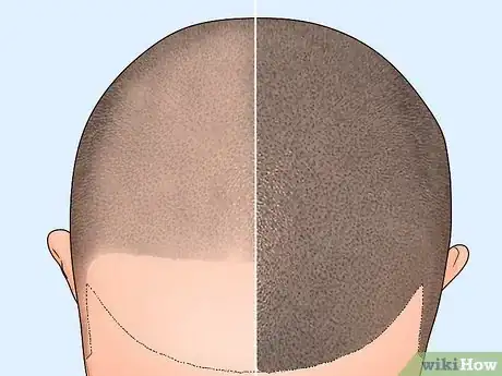 Image titled Treat Male Pattern Hair Loss Step 11