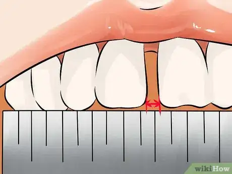 Image titled Get Rid of Gaps in Teeth Step 3