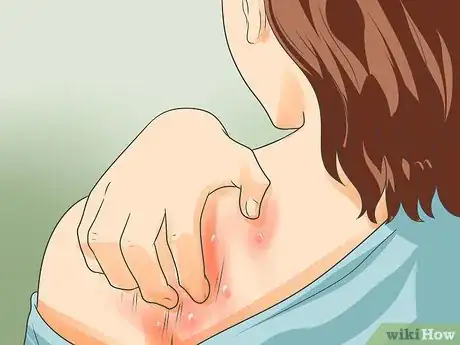 Image titled Recognize Scabies Rash Step 1