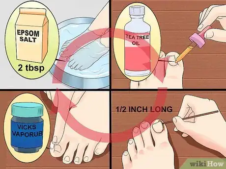 Image titled Heal an Ingrown Toenail Step 5