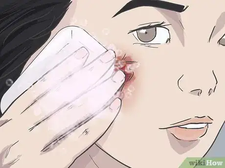 Image titled Prevent Scarring on Your Face Step 1