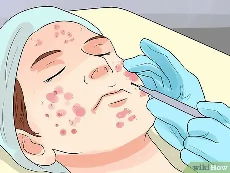 Image titled Decrease the Size of a Pimple Overnight Step 9