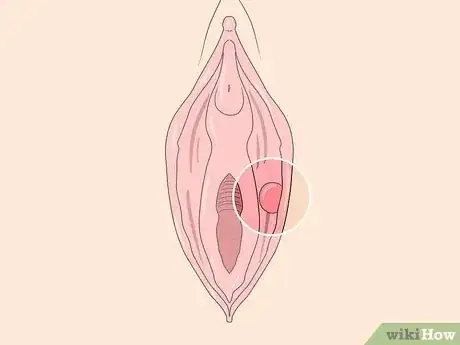 Image titled Recognize Vulva Cancer Symptoms Step 7