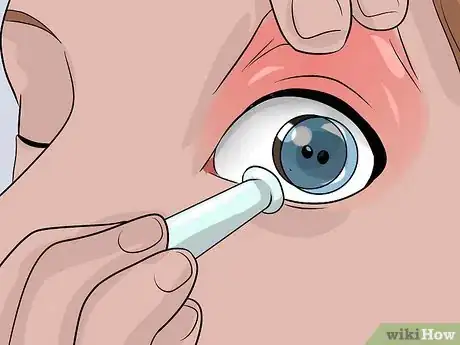 Image titled Remove Soft Contact Lenses After You Have Slept With Them Step 13