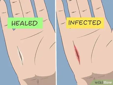 Image titled Prevent a Cut from Getting Infected Step 12