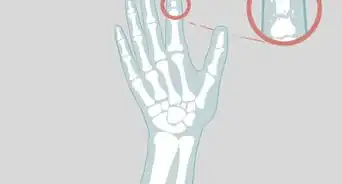 Determine if a Finger Is Broken