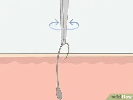 Image titled Get Rid of Ingrown Pubic Hair Step 10