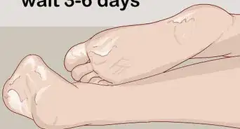 Use an Exfoliating Foot Peel