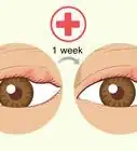 Get Rid of Puffy Eyelids