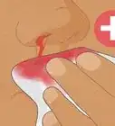 Know if You Have Internal Bleeding