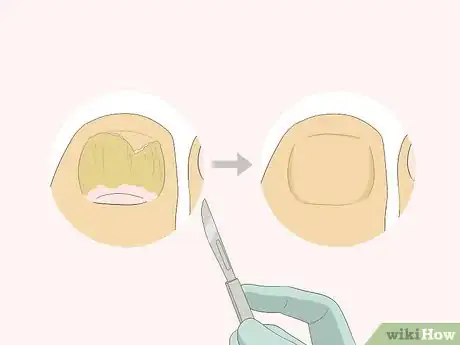 Image titled Get Rid of Nail Fungus Step 9