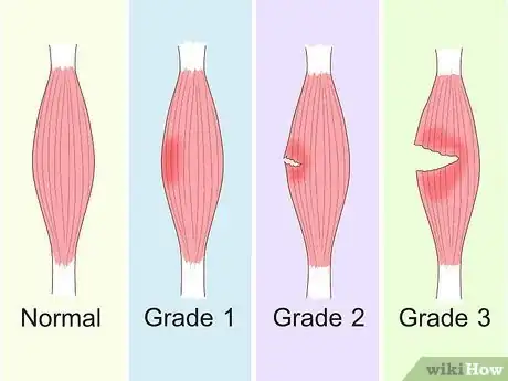 Image titled Treat Quad Strain Step 17