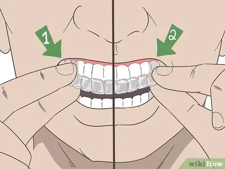 Image titled Put Invisalign Back in if You Haven't Worn Them for a Long Time Step 2