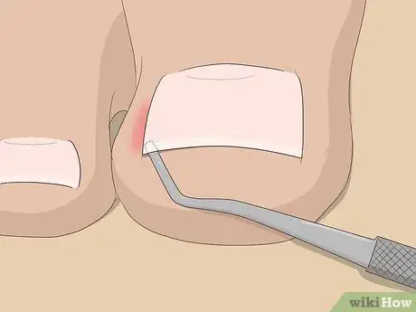 Image titled Relieve Ingrown Toe Nail Pain Step 15