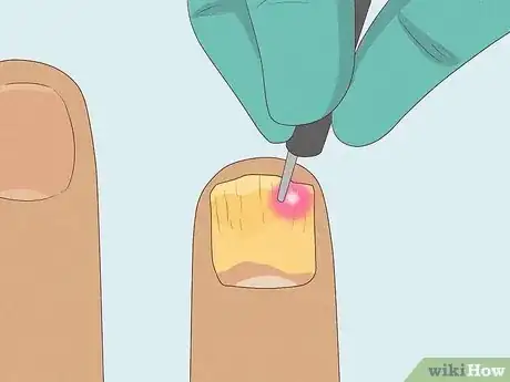 Image titled Cure Nail Fungus Step 11