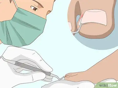 Image titled Relieve Ingrown Toe Nail Pain Step 24