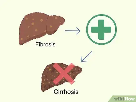 Image titled Treat Liver Fibrosis Step 20