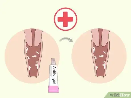 Image titled Get Rid of a Yeast Infection at Home Step 8