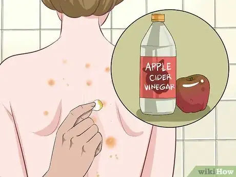 Image titled Get Rid of Back Acne Fast Step 8