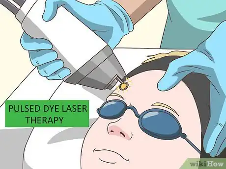 Image titled Remove Facial Warts Step 11