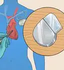 Treat Tachycardia