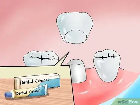 Image titled Avoid Dental Crown Problems Step 3