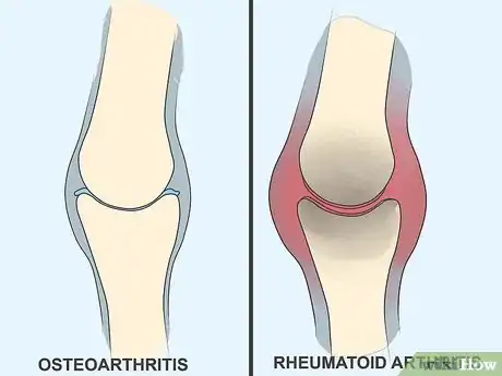 Image titled Recognize Arthritis Symptoms Step 11