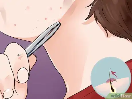 Image titled Remove Ingrown Hair on Your Face Step 2