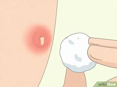 Image titled Instantly Get Rid of a Pimple (Cotton Ball Popping Method) Step 4