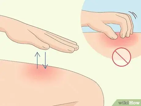 Image titled Get Rid of Itchy Skin with Home Remedies Step 10