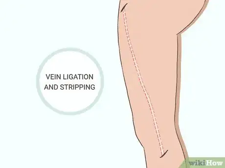 Image titled Get Rid of Varicose Veins Step 5