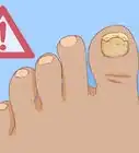 Help a Toenail Grow Back Quickly