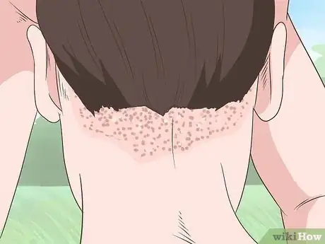 Image titled Heal Scalp Eczema Step 1