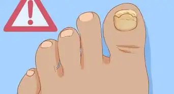 Help a Toenail Grow Back Quickly