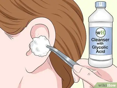 Image titled Get Blackheads Out of Your Ear Step 1