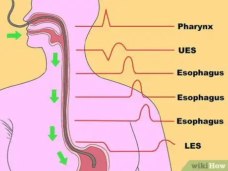 Image titled Know if You Have a Hiatal Hernia Step 10