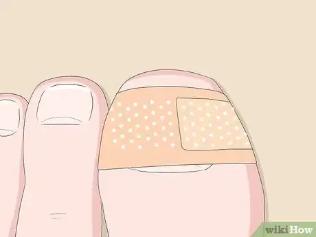 Image titled Relieve Ingrown Toe Nail Pain Step 11