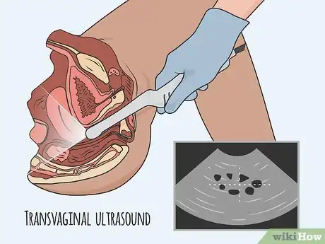 Image titled Remove Uterine Polyps Step 10