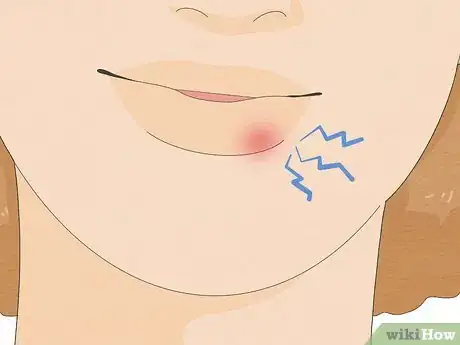 Image titled Get Rid of a Cold Sore Fast Step 17