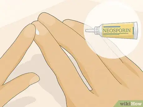 Image titled Get Rid of Hangnails Step 3