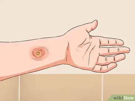 Image titled Get Rid of MRSA Step 1