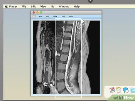 Image titled Read an MRI Step 12