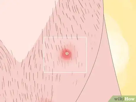 Image titled Spot Ingrown Hairs Step 4