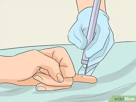 Image titled Get Rid of Warts on Fingers Step 5