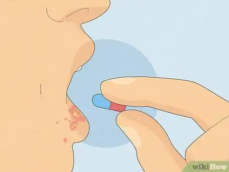 Image titled Recognize Herpes Step 10