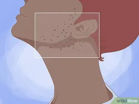 Image titled Spot Ingrown Hairs Step 5