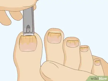 Image titled Cure Toenail Fungus with Vinegar Step 1