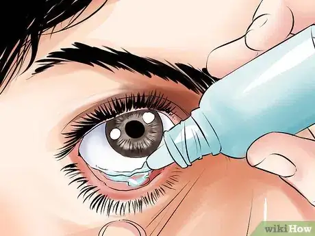 Image titled Heal a Scratched Cornea Step 15